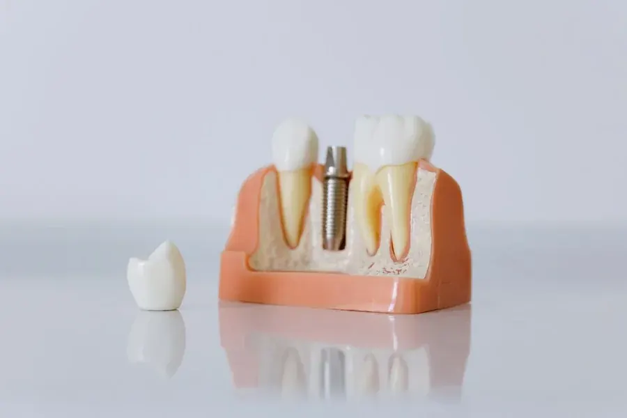 Model implantu z koroną protetyczną